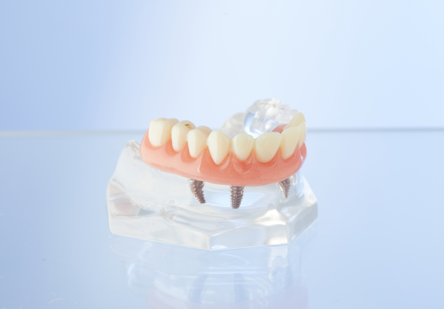 Aspen Dental Dentures Cost