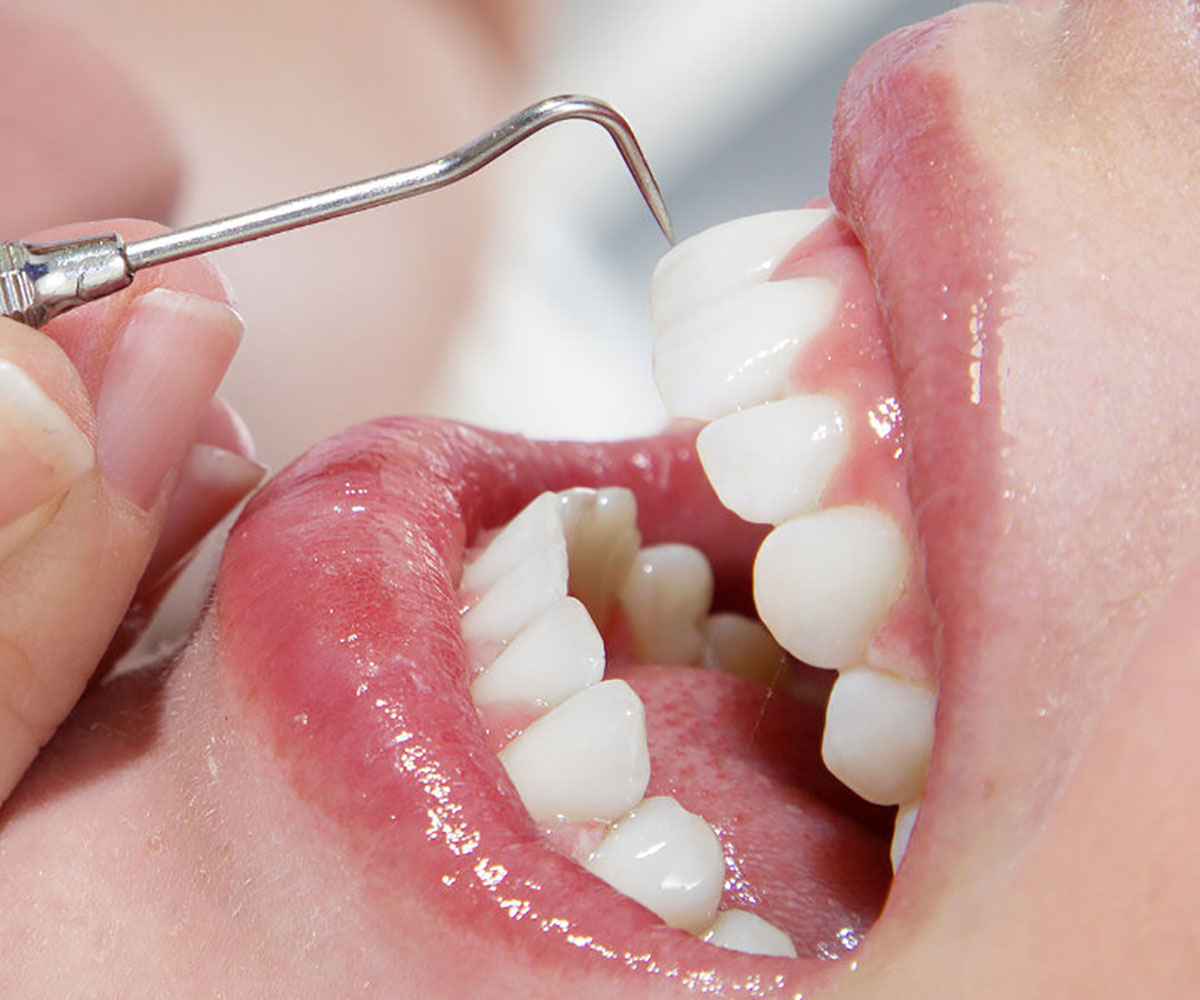 Aspen Dental Teeth Cleaning: Boost Oral Health