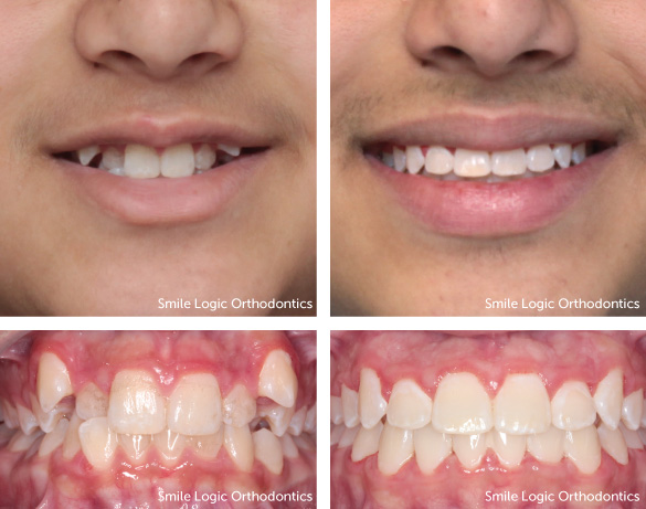 Bad Teeth After Braces Bad Teeth After Braces
