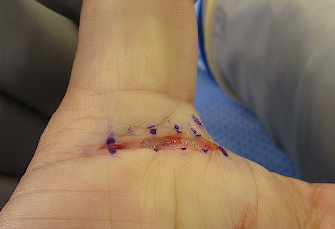 Bandage After Trigger Thumb Surgery