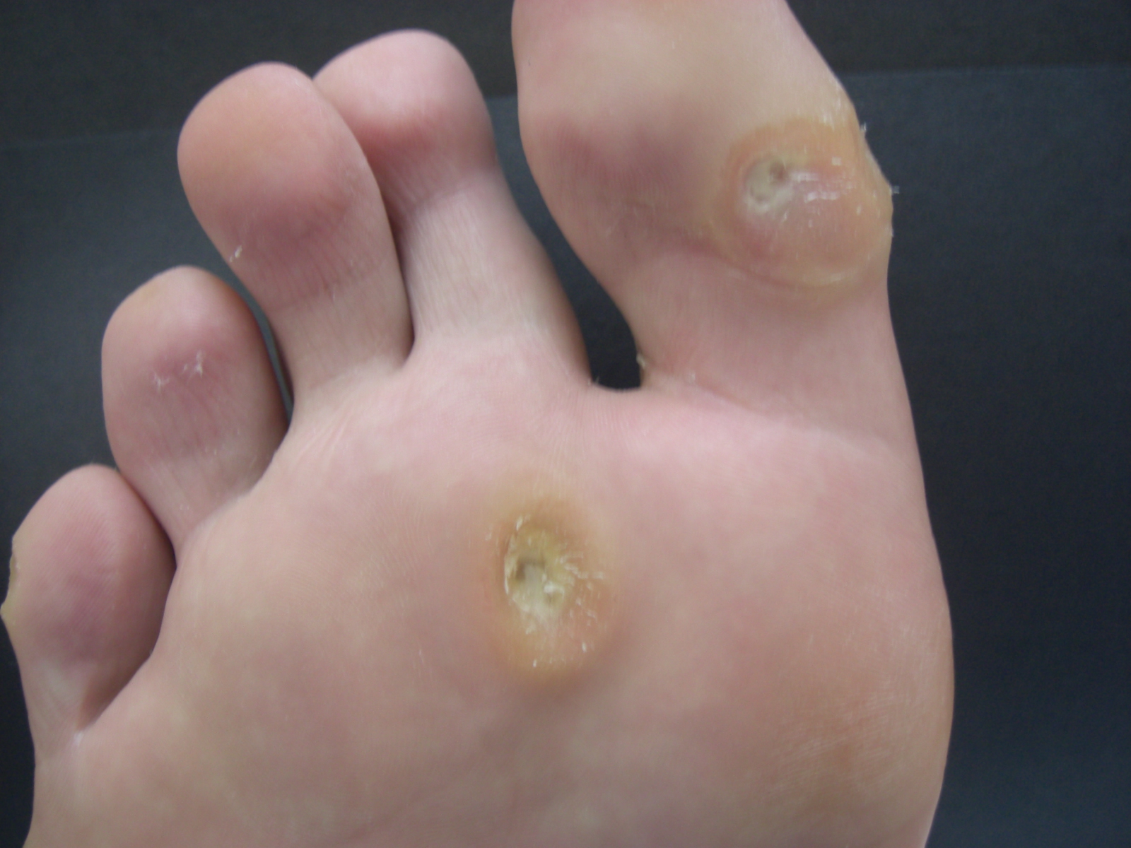 Big Toe Removal