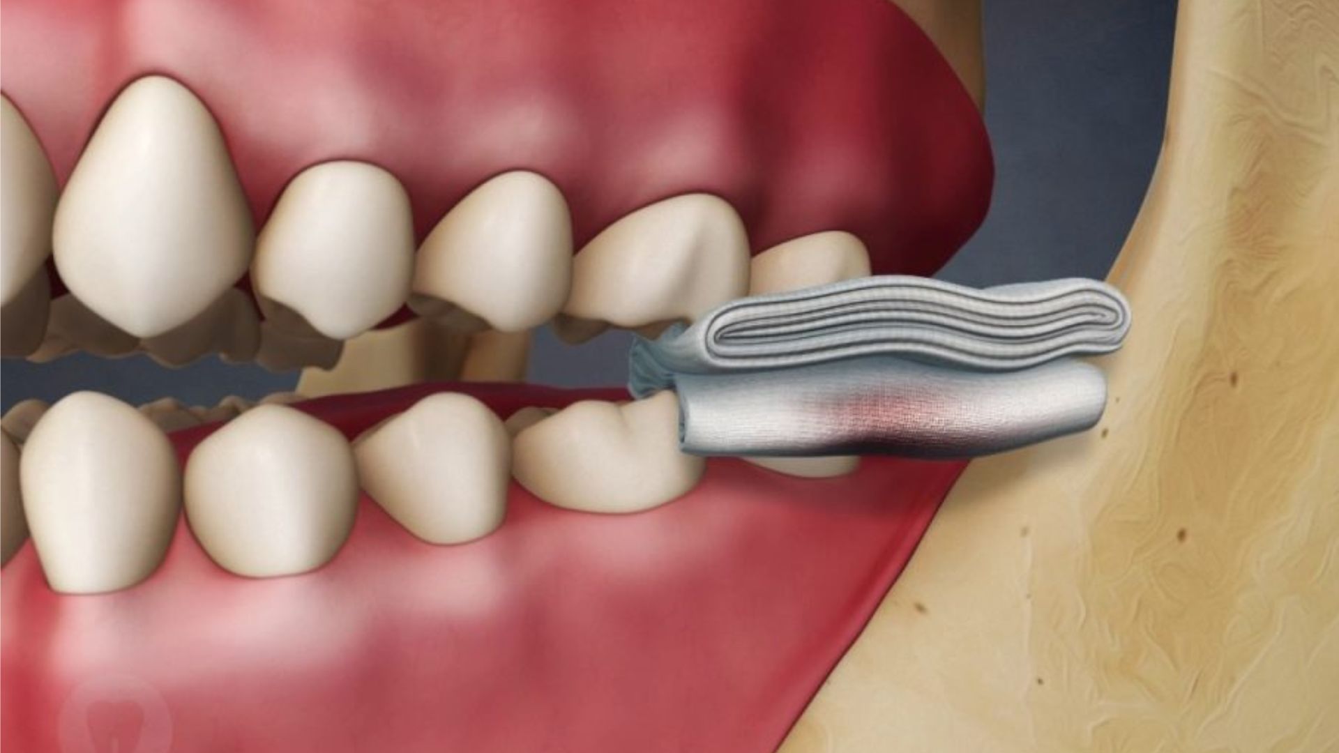 Biting Cheek: Relieve Wisdom Teeth Pain Biting Cheek: Relieve Wisdom Teeth Pain