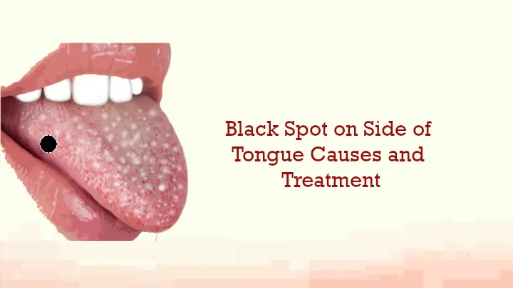 Black Spot Tongue Causes