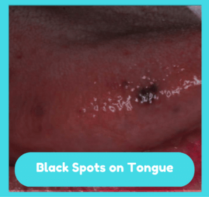 Black Spots On The Tongue