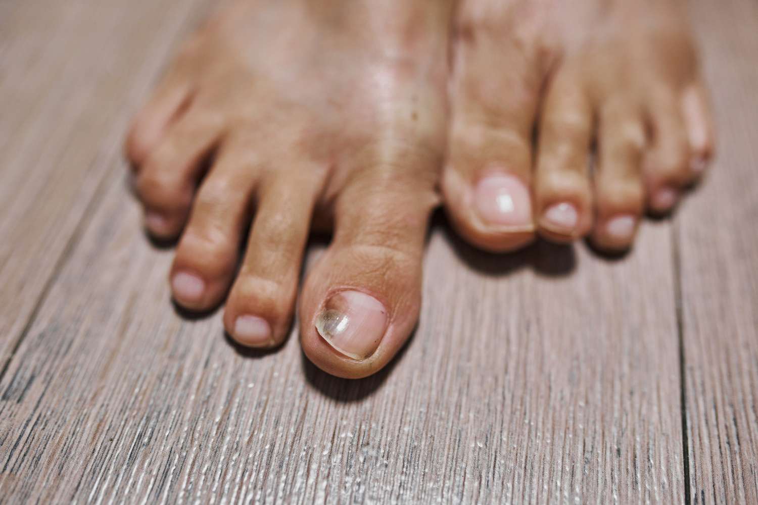 Black Toenail Cause