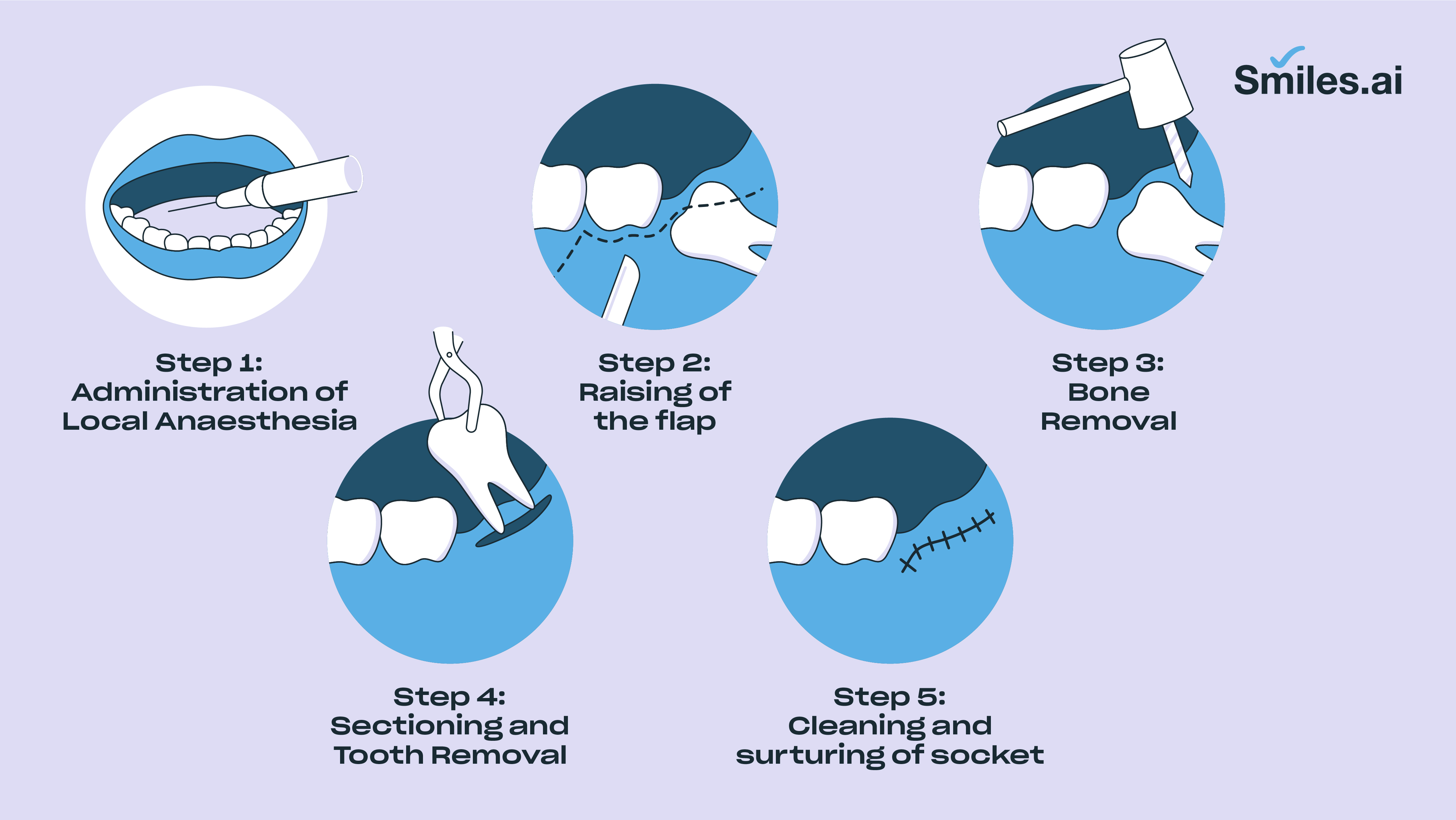 Black Wisdom Tooth Removal Guide