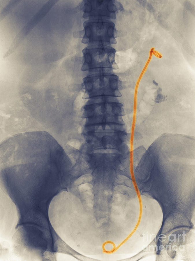 Bladder Stent Pain