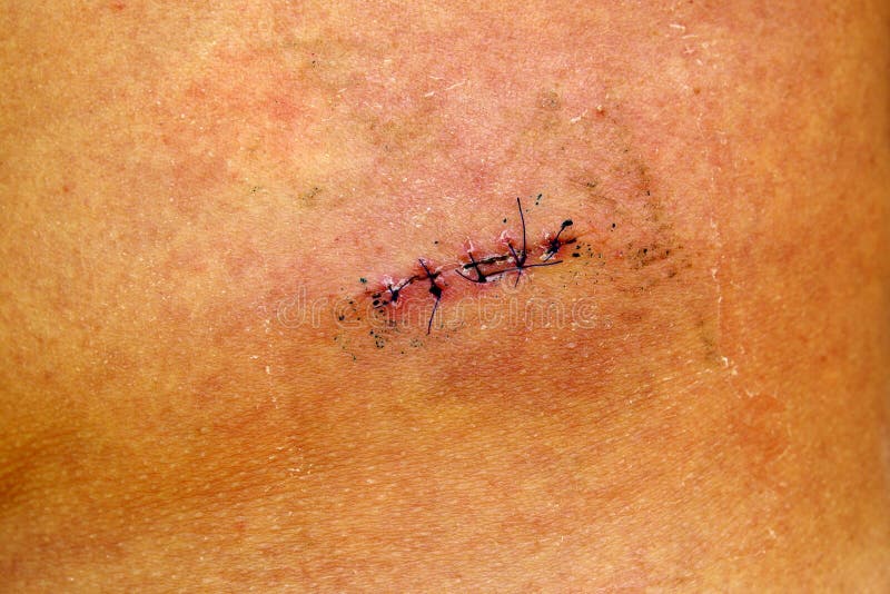 Bleeding From Incision After Surgery