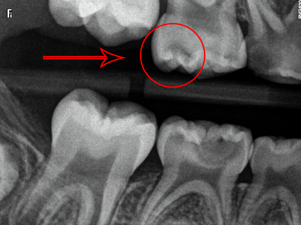 Blue Spot Tooth: Identify And Treat Causes