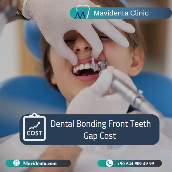 Bonding Teeth Gap