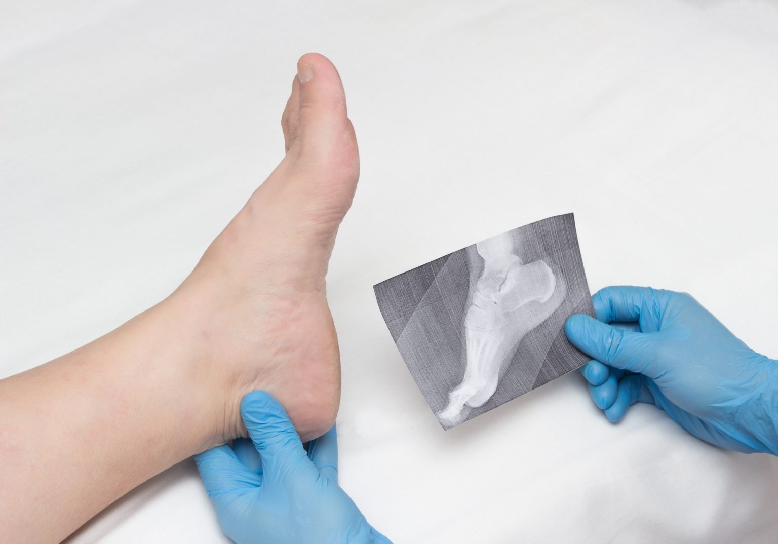 Bone Spurs Teeth Relief