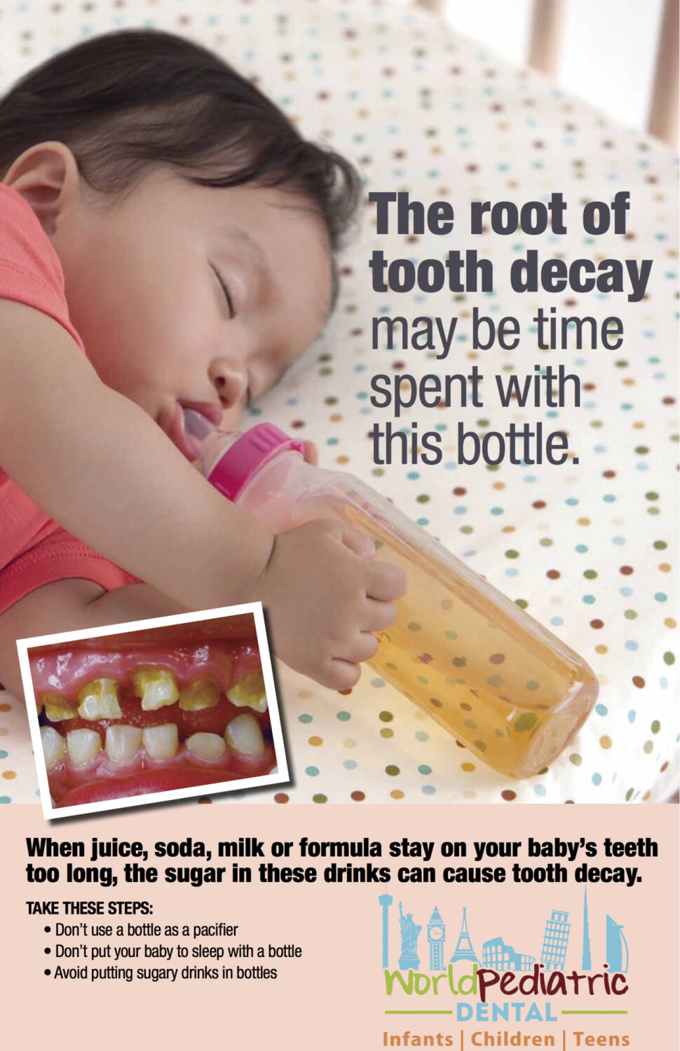 Bottle Feeding And Tooth Decay
