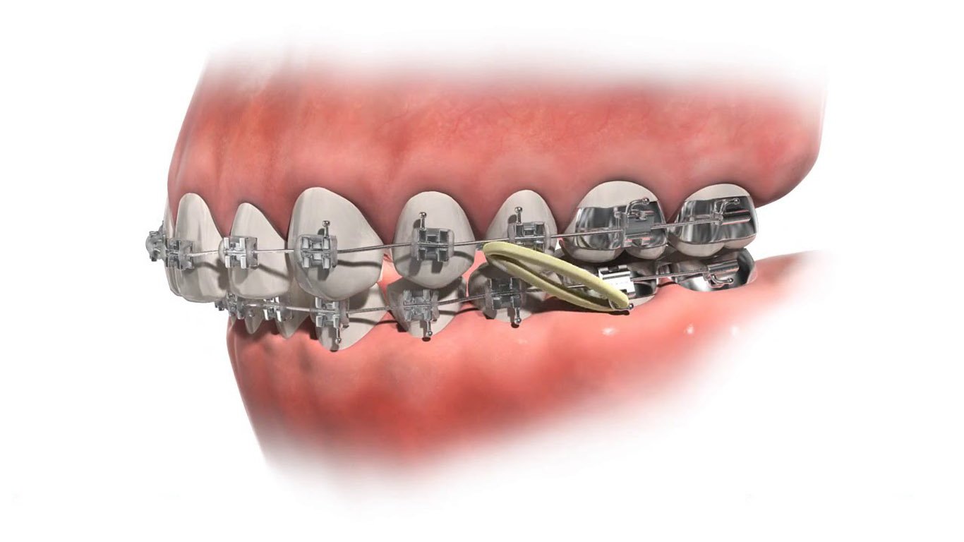 Braces Alternative Options