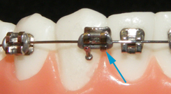 Braces Bracket Broke