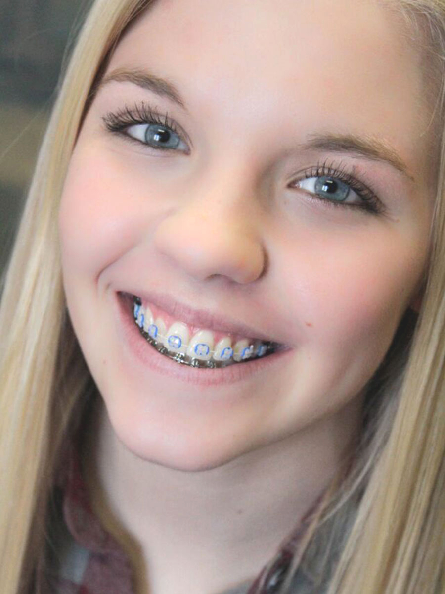 Braces In 2024 Braces Colors Cute Braces Cute Braces Colors Braces In 2024 Braces Colors Cute Braces Cute Braces Colors