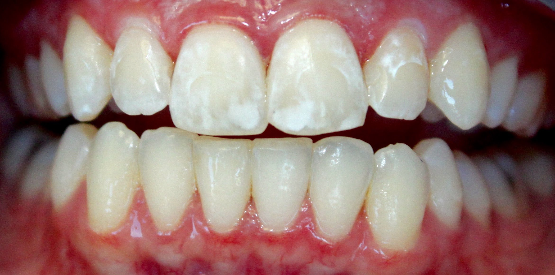 Braces Marks On Teeth