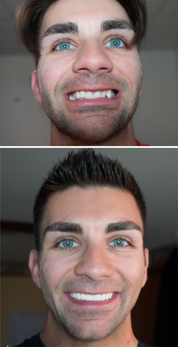 Braces Off Before And After