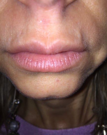 Broken Blood Vessel In Lip