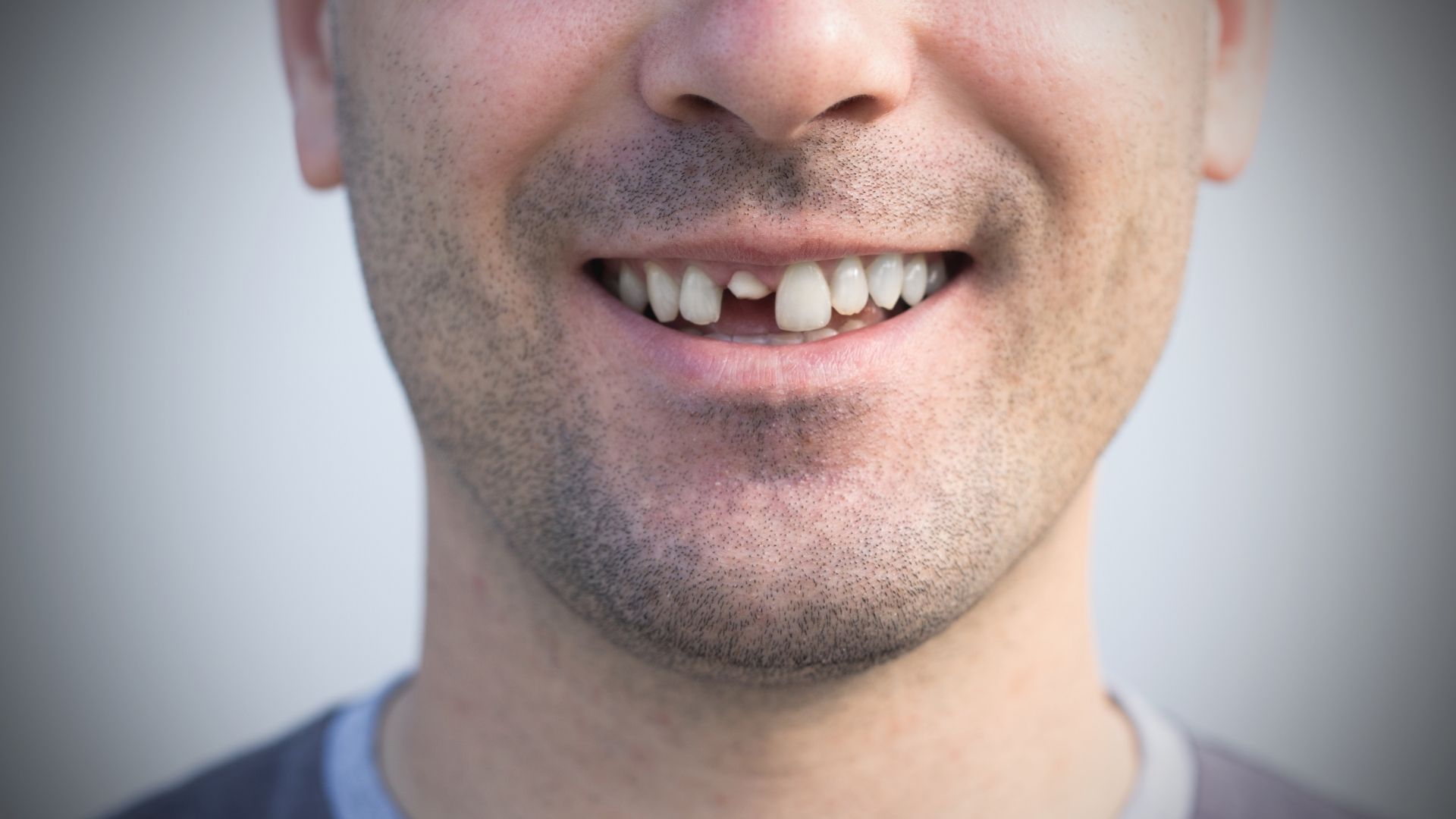 Broken Tooth Emergency: Get Instant Relief