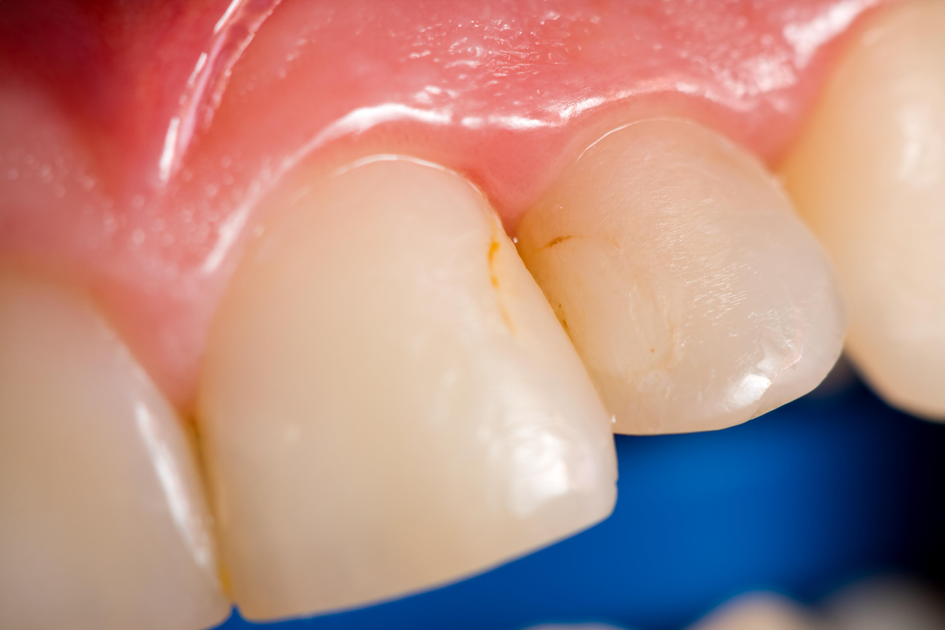 Brown Spots On Teeth: Easy Fix At Home