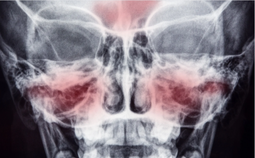 Can Sinus Cause Dry Mouth