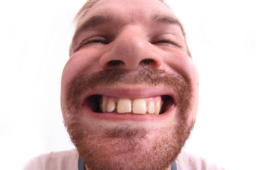 Can Teeth Be Shaved Down