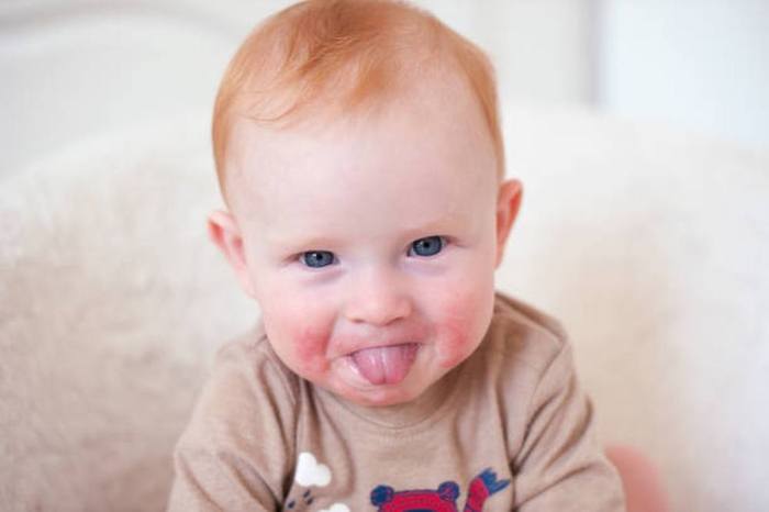 Can Teething Cause Cheek Rash
