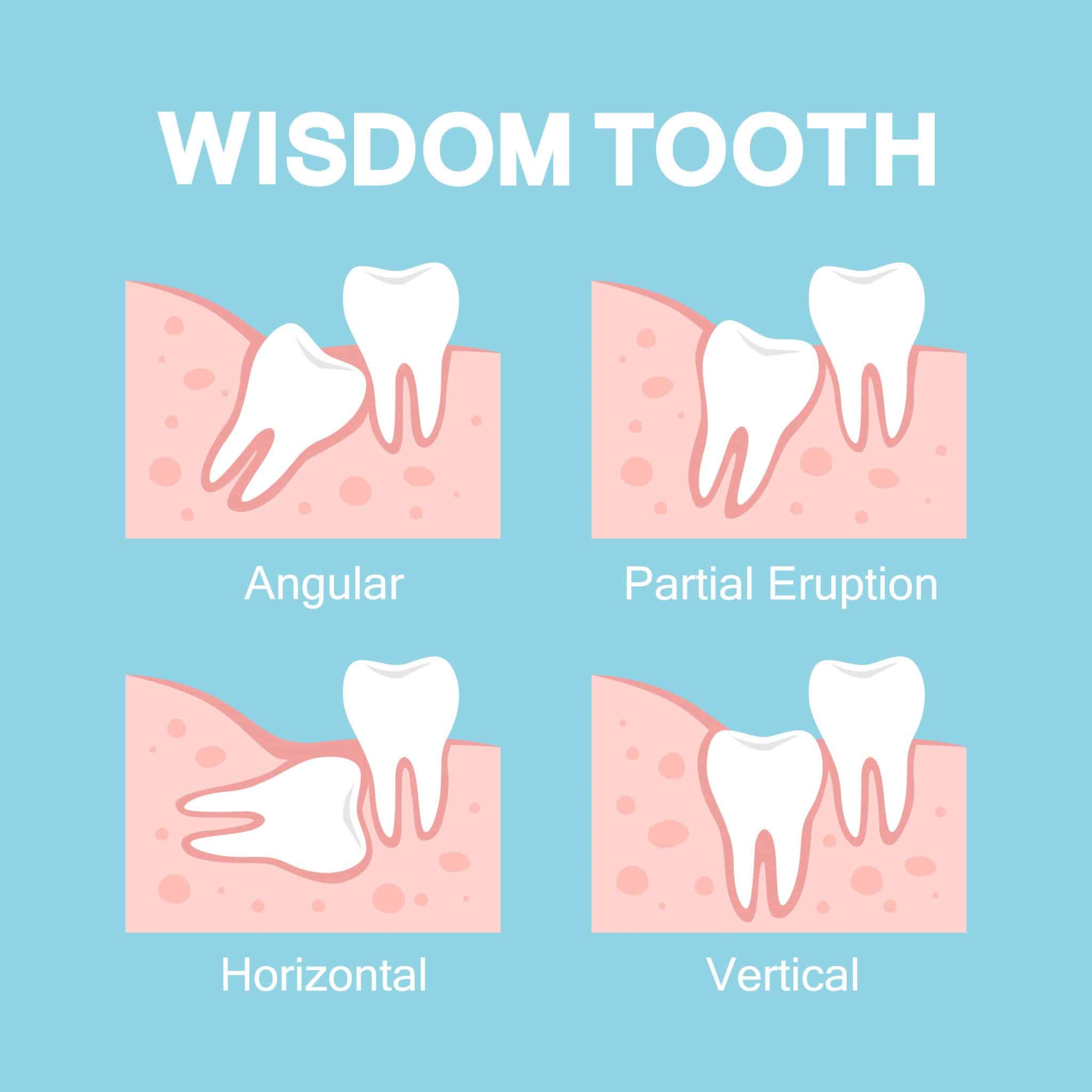Can Wisdom Teeth Come Back