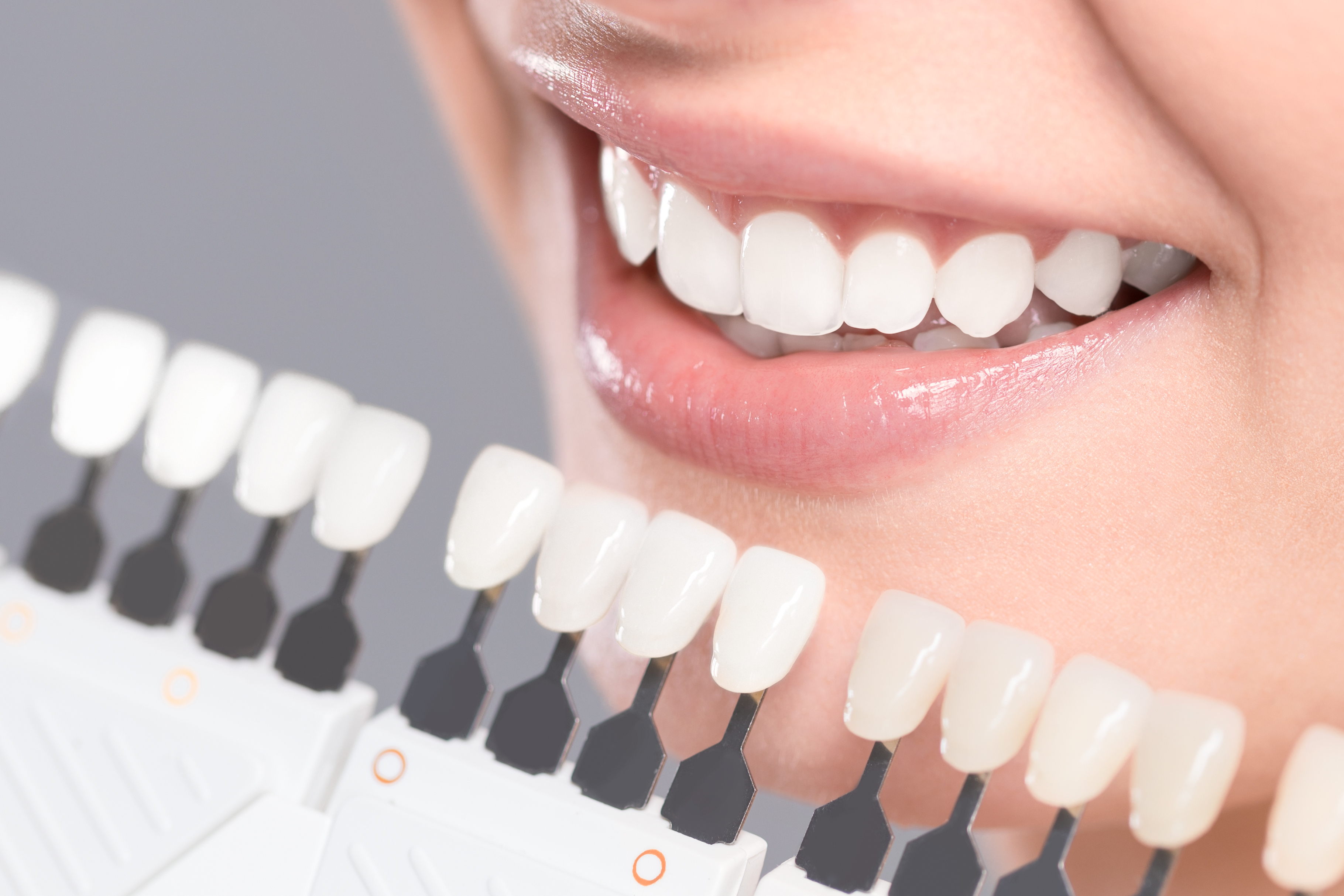 Can You Whiten Crown Teeth