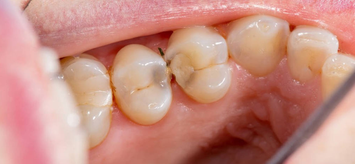Cavities Between The Teeth