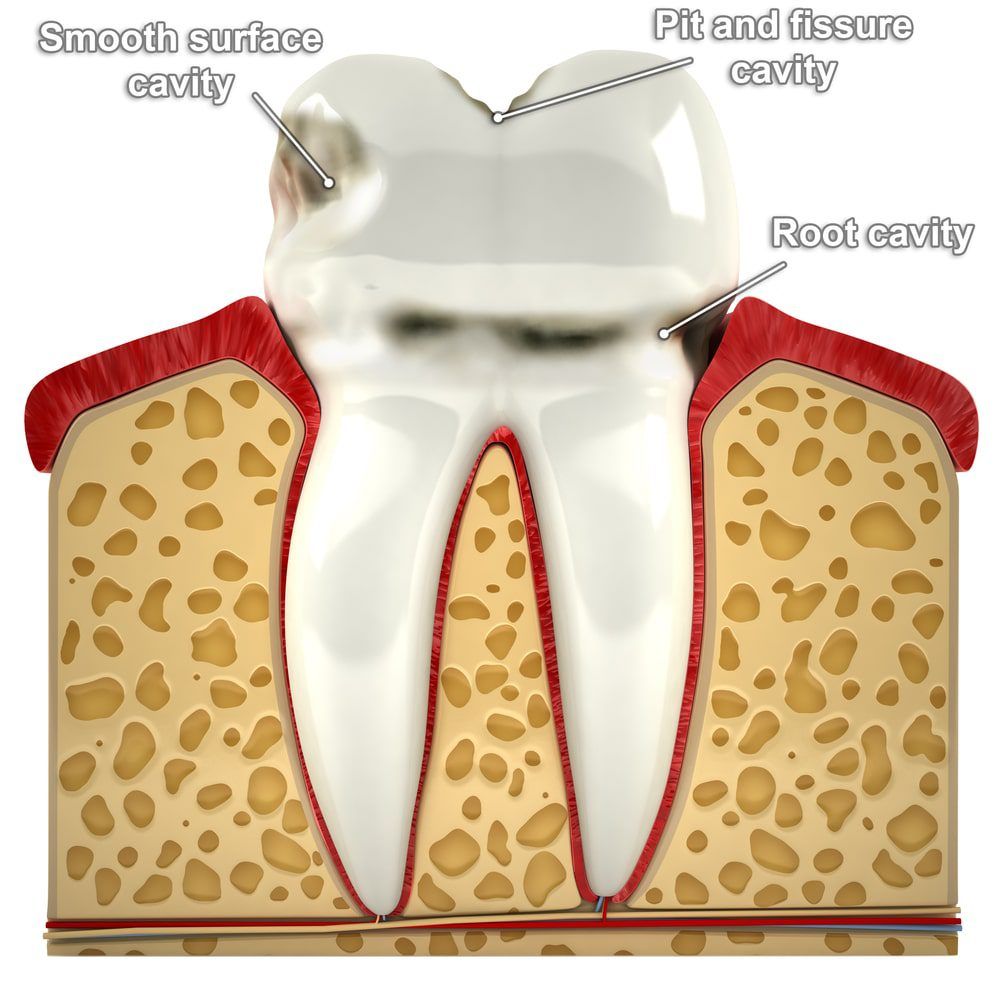 Cavity At The Gumline