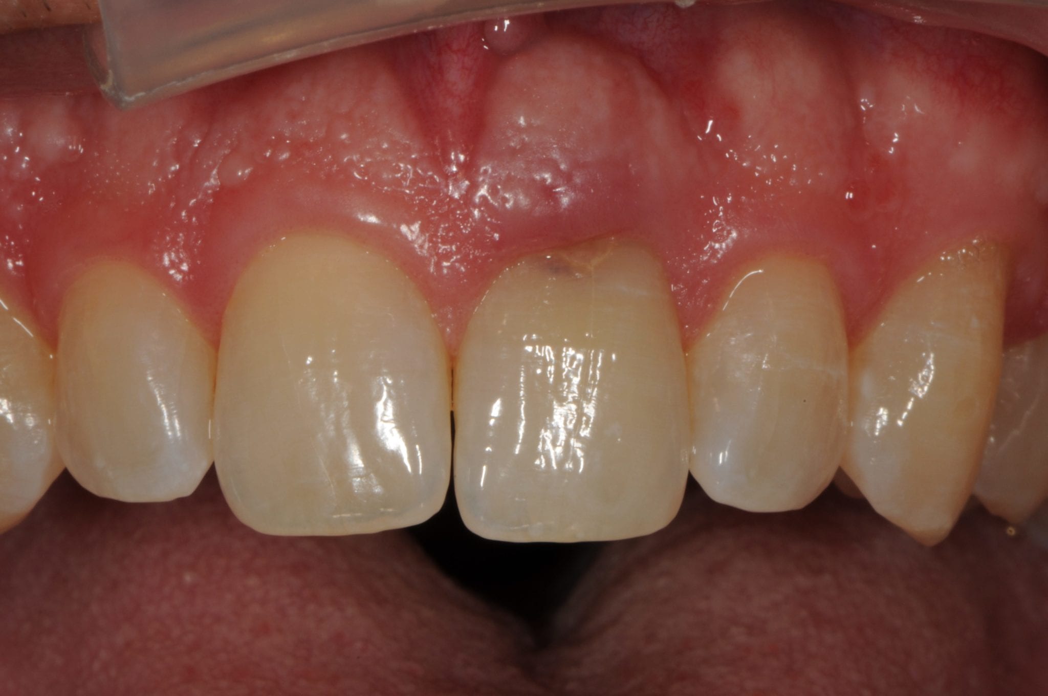 Cavity Front Of Tooth Cavity Front Of Tooth