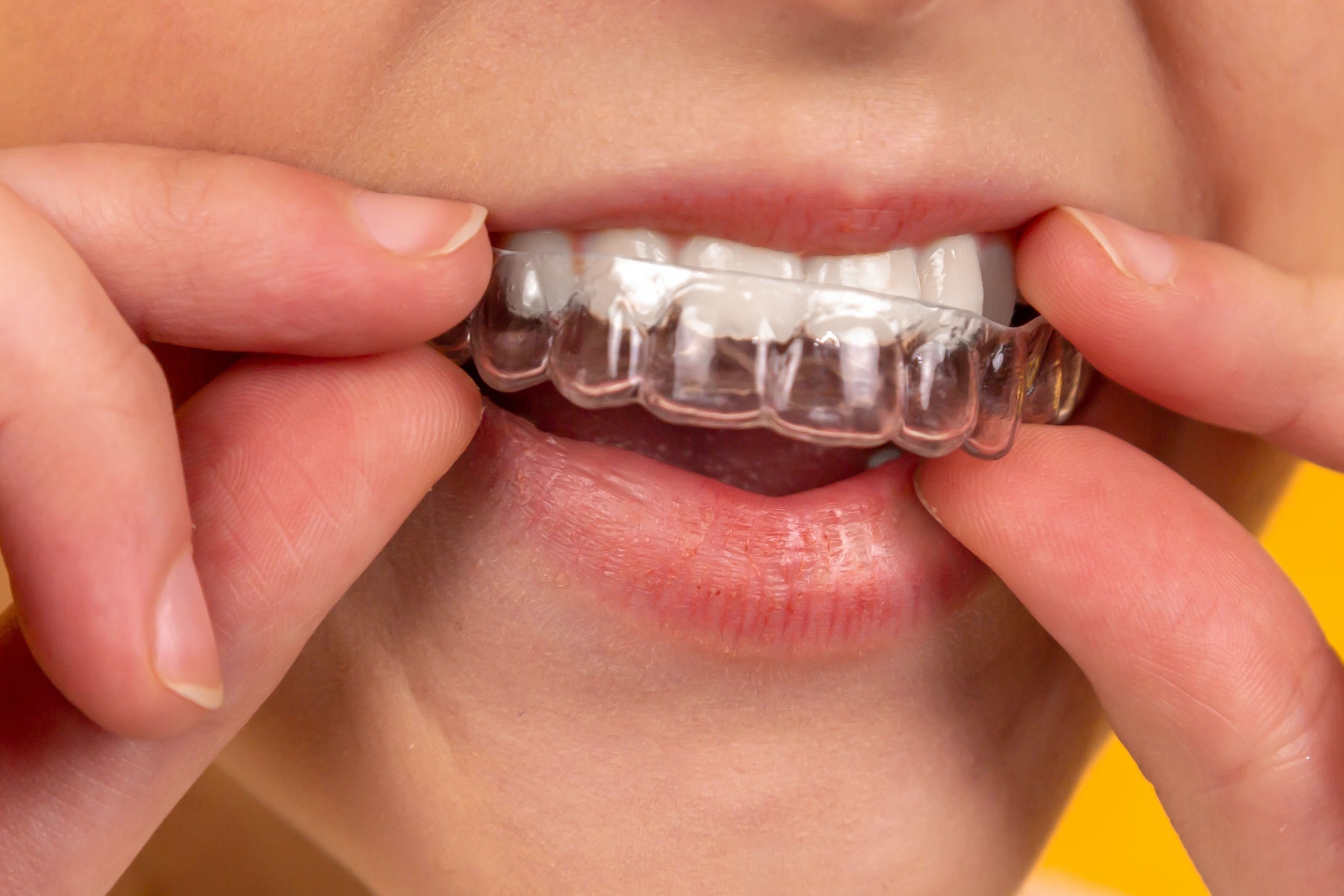 Cheapest Place To Get Braces