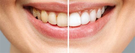 Chemical Burn On Gums: Fast Relief And Healing Chemical Burn On Gums: Fast Relief And Healing