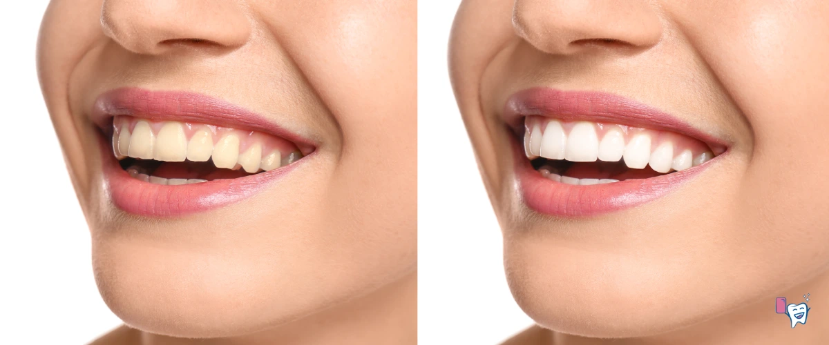 Chewing Gum Whiten Teeth Chewing Gum Whiten Teeth
