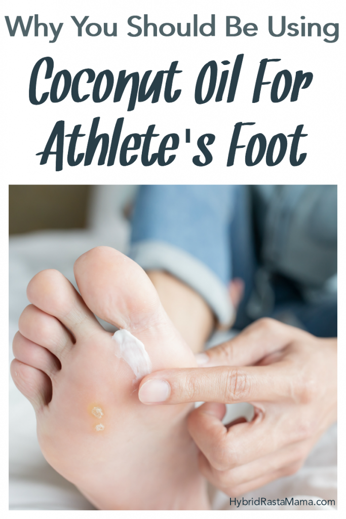 Coconut Oil And Tinea Versicolor