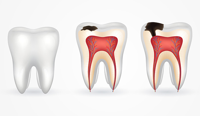 Como Eliminar Las Caries Rápido Como Eliminar Las Caries Rápido