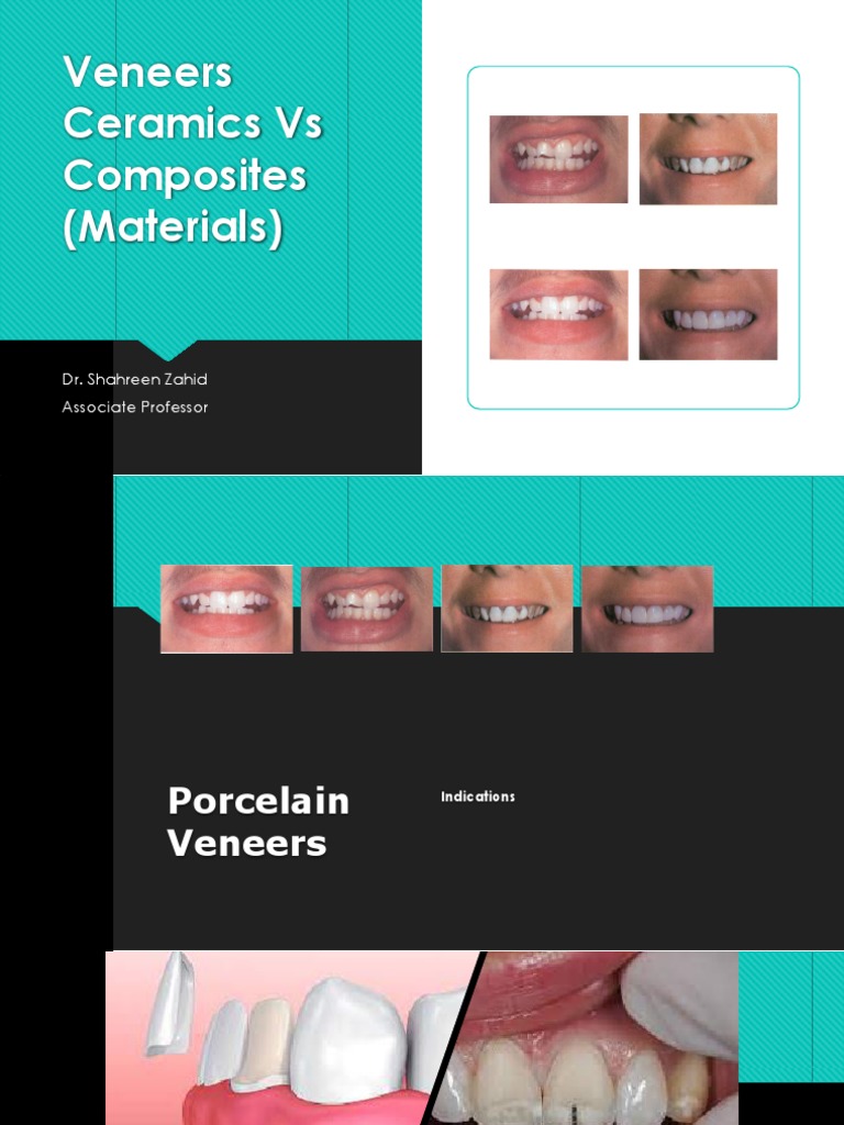 Composites Vs Veneers