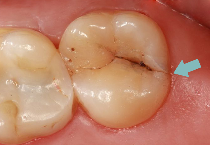 Cracked Wisdom Tooth