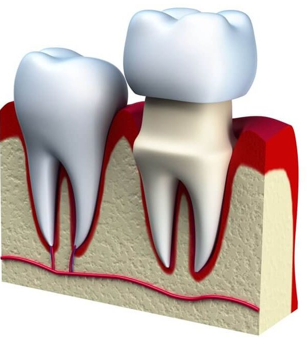Crown Lengthening Gone Wrong