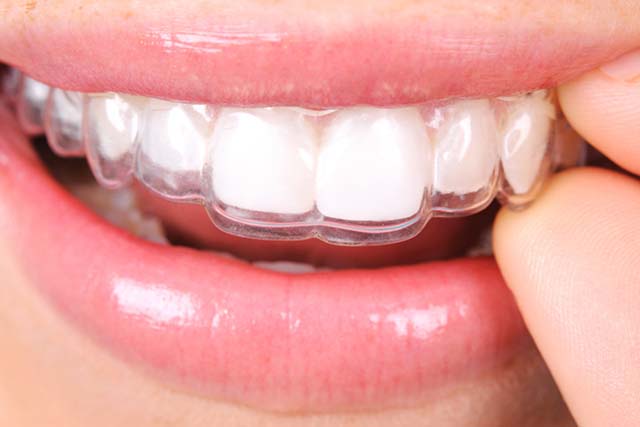 Crowns And Bridges: Fix Teeth Permanently