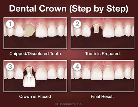 Crowns On Teeth Cost