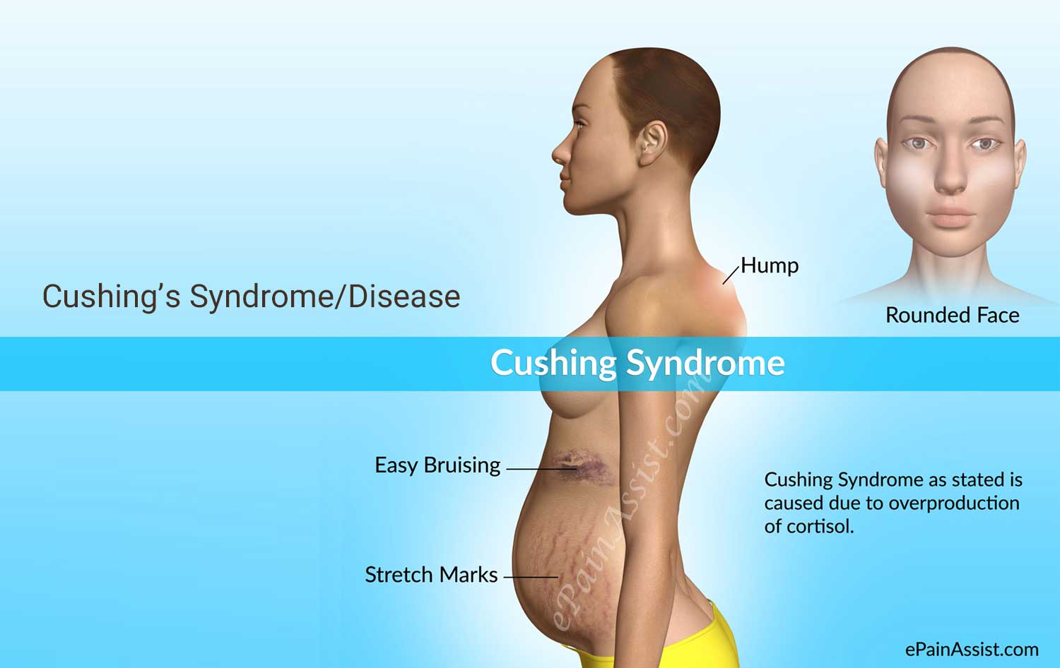 Cushing Syndrome Photos