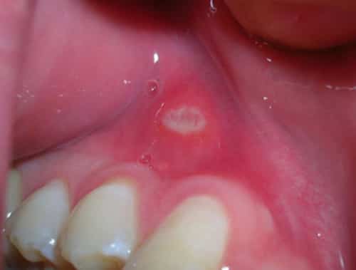 Cut On Gums Above Tooth