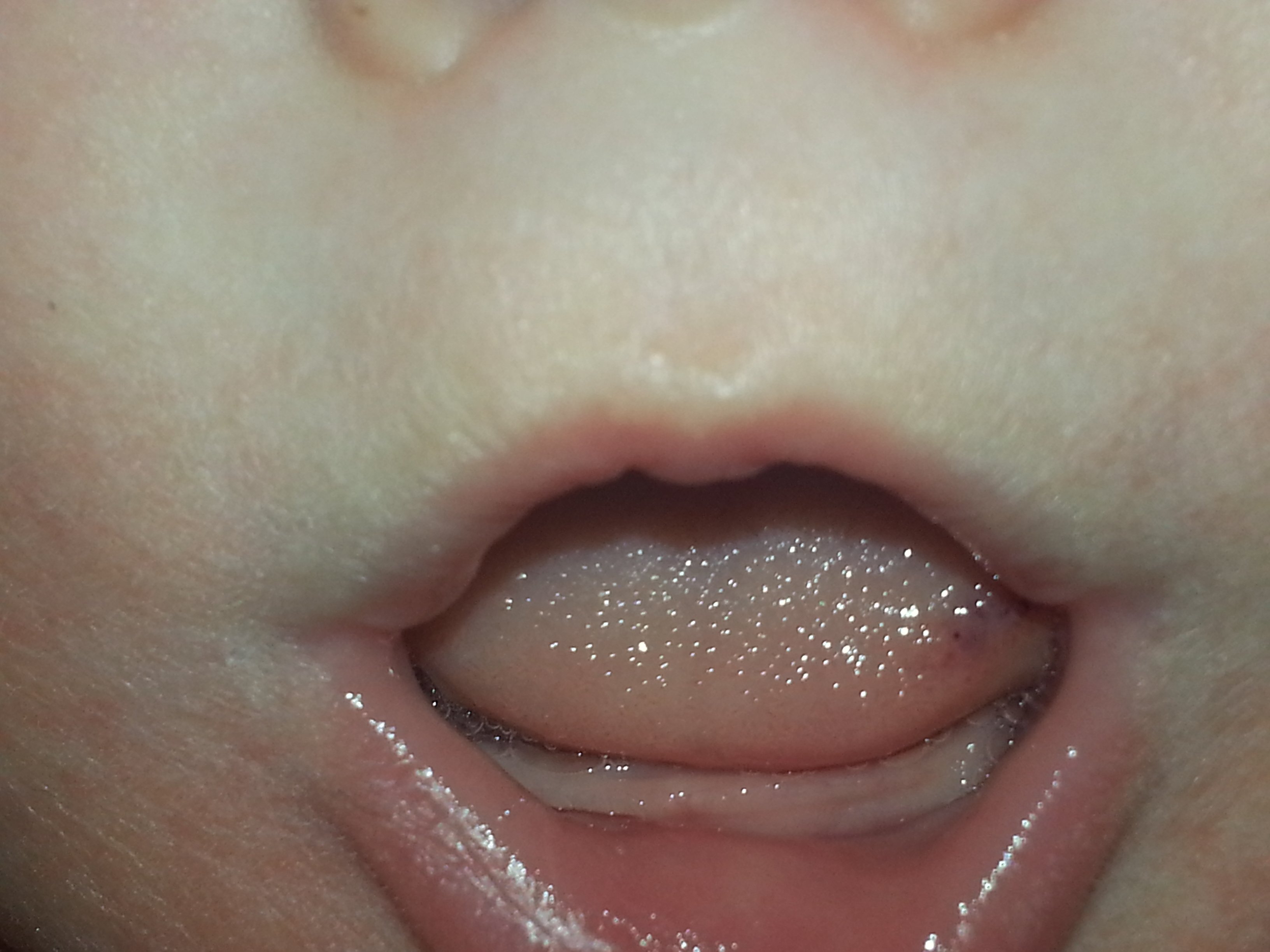 Dark Spot On Tongue