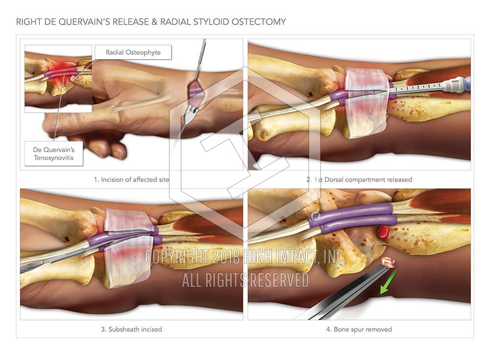 De Quervain Surgery: Heal In 68 Weeks Guaranteed