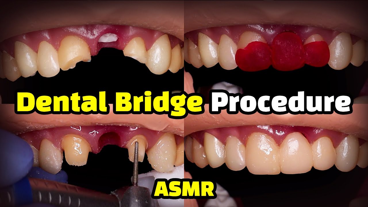 Dental Bridge Front