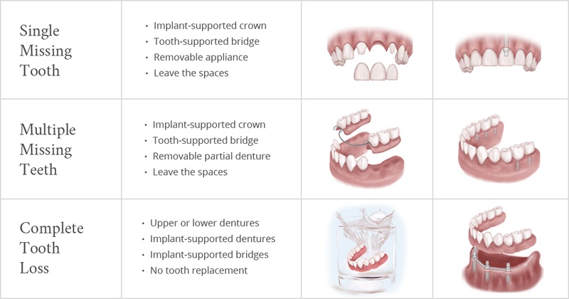 Dental Cap Pricing: Know Your Treatment Options