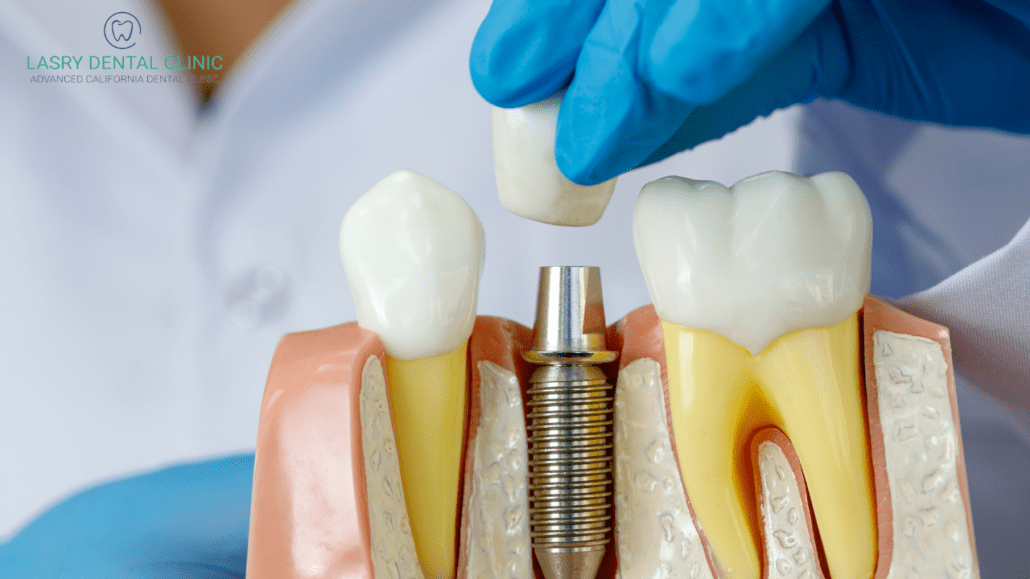 Dental Implant Cost Near Me