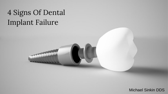 Dental Implant Failure: Know The Signs